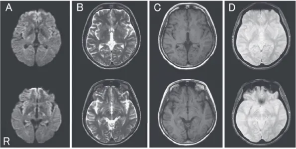 Fig. 1 MRI obtained on the day of the clinical onset. (A) Diffusion weighted image (DWI) (axial,  1.5T;  TR  6,500ms,  TE  120ms,  b  value:  1,000see/mm 2 ),  (B)  T 2   weighted  image  (axial,  1.5T;  TR  4,200ms, TE 100ms), (C) T 1  weighted image (axi