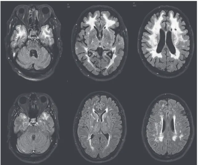 Fig. 2 Upper:  A  75-year-old  male  could  not  remember  a  new  way,  calculate  a  simple  task  and  brain CT showed asymptomatic old lacunar infarction at 70 years of age. He was admitted to the   another hospital due to a right lower leg palsy at 74