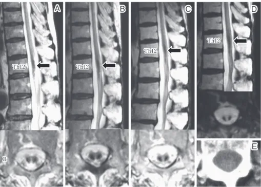 Fig. 5 Time course of spinal MRI, spinal CT after rituximab-containing chemotherapy. A: T 2  weighted (top: sagittal, 1.0 T; TR 3,300 ms, TE 120 ms, bottom: axial, at Th12 spinal level, 1.0  T; TR 3,000 ms, TE 108 ms) image on June 2010