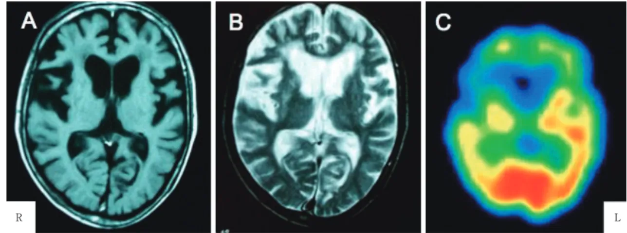 Fig. 1 Magnetic resonance imaging and 99mTc-ECD SPECT imaging of the brain, 5 years before  death.