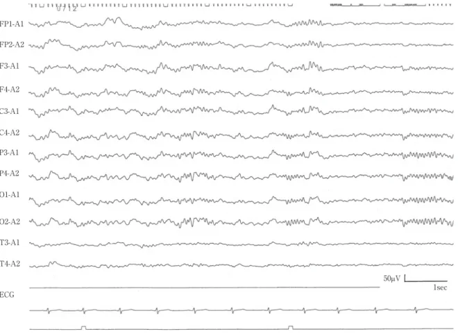 Fig. 1 The  EEG  showed  sleep-like  spindle  pattern  in  the  comatose  25-years-old  man  at  the  4 th   hospital day.FP1-A1FP2-A2F3-A1F4-A2C3-A1C4-A2P3-A1P4-A2O1-A1O2-A2T3-A1T4-A2ECG 50PV 1sec ステロイドパルス療法（メチルプレドニゾロン 1,000mg! 日， 3 日間）を追加した．第 4  病日にはレベルは