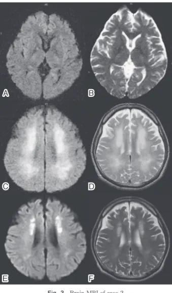 Fig. 2 Brain CT and MRI of case 1.