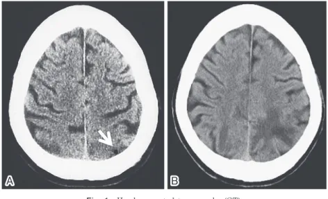 Fig. 1 Head computed tomography (CT). A: head CT performed immediately after onset shows a gas babble in left parietal lobe (arrowhead)
