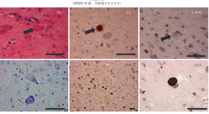 Fig. 3 剖検症例（FALS 1-2）の病理所見（中脳被蓋部）．