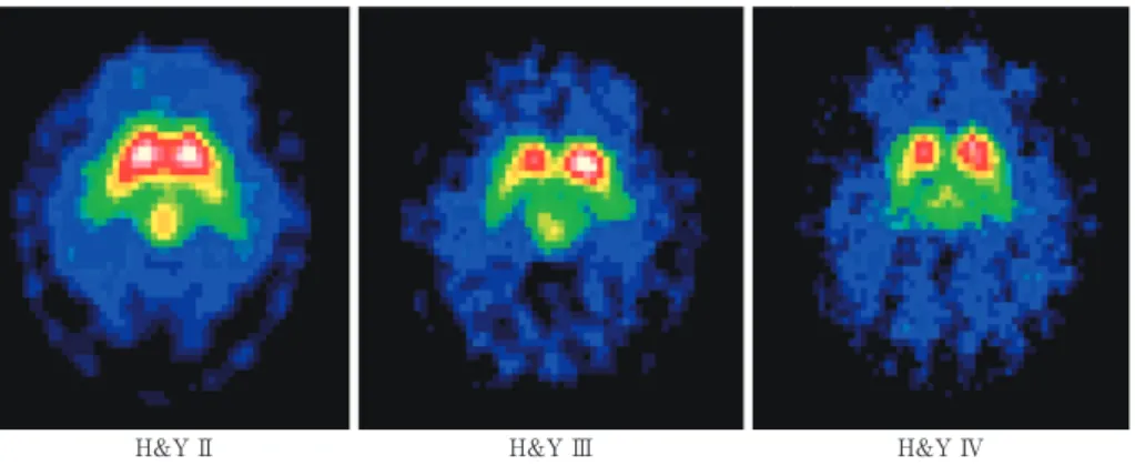 Fig. 3 βCIT（ドパミントランスポータのトレーサ）の画像．