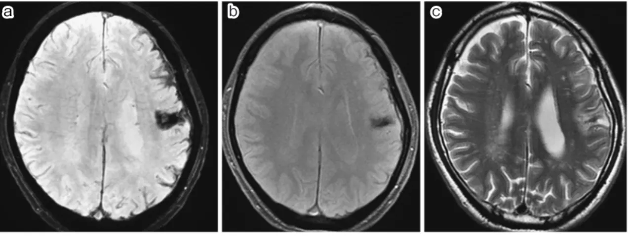 Fig. 2 撮影法による違い―GRE 法 vs. SWI 法．