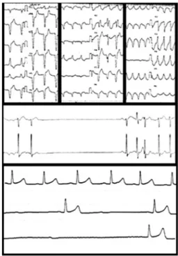 Fig. 1 Electrocardiogram  in  myasthenia  gravis  patients  with anti-Kv1.4 antibodies. (A) ventricular tachycardia, (B)  sick  sinus  syndrome  and  (C)  complete  atrial  ventricular  block.（文献 2 より引用） 自己抗体は S-35 でラベルした横紋筋肉腫細胞（RD）の抽出液 を抗原とした免疫沈降法で同定した ４）