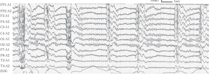 Fig. 1 Electroencephalogram on emergency: