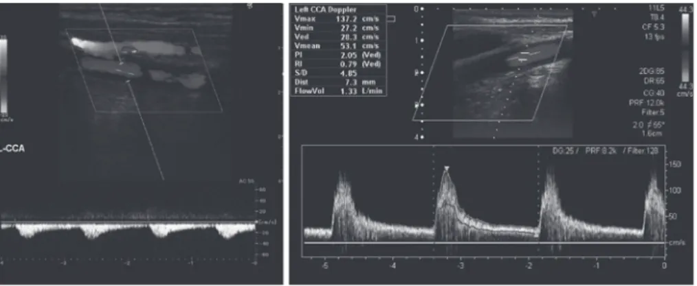 Fig. 2 The Doppler spectrum within the left ophthalmic artery.