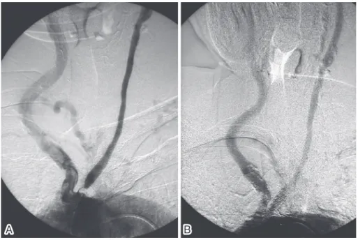 Fig. 3 Aortography (anteroposterior view).