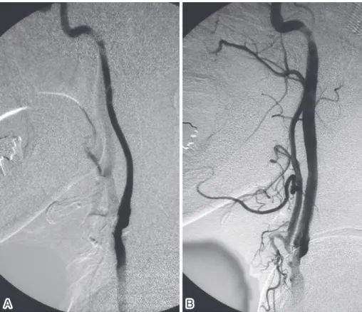 Fig. 4 Angiography of the cervical segment of the left common carotid artery (lateral view)