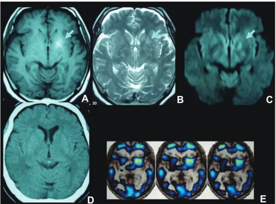 Fig. 2 Time courses of T 1 -weighted MRI and T 2 ＊  gradient-echo MRI of the brain.