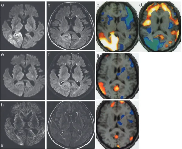 Fig. 1 Axial  diffusion  weighted  imaging  (DWI)  (repetition  time  (TR),  4,100.0  ms;  echo  time  (TE),  88.0 ms ; a, e, h) and fluid attenuated inversion recovery (FLAIR) weighted imaging (TR, 9,000.0  ms; TE, 114.0 ms; b, g, i),  123 I-IMP brain SPE