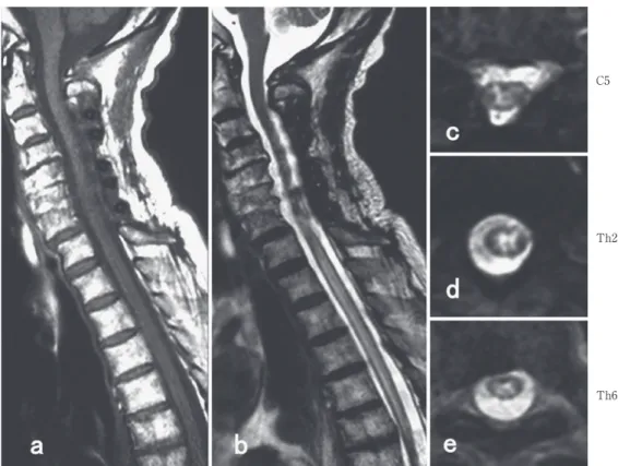 Fig. 3 Spinal MRI findings on day 12. Spinal MRI showed an edematous, longitudinally extensive  cord  lesion  at  the  C5-Th6  level  of  the  spine.  The  images  showed  postoperative  artifacts.  a:  T 1   weighted  image:  sagittal,  1.5  T;  TR  2,608