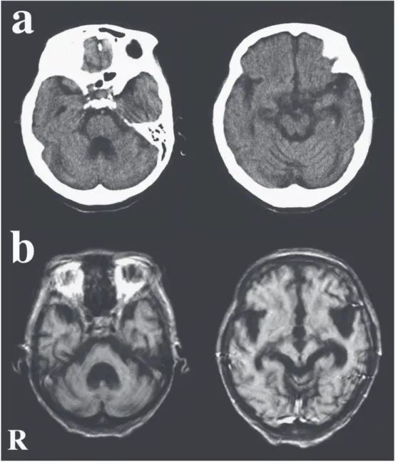 Fig. 1 Cranial CT and MRI findings.