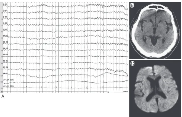 Fig. 1 Electroencephalogram  after  treatment  with  dantrolene  (A).  No  epileptic  discharges  were  observed 10 days after the initial convulsion. Head computed tomography at the seizure onset (B)  and MR Diffusion weighted image (Axial, 1.5T; TR 3,333