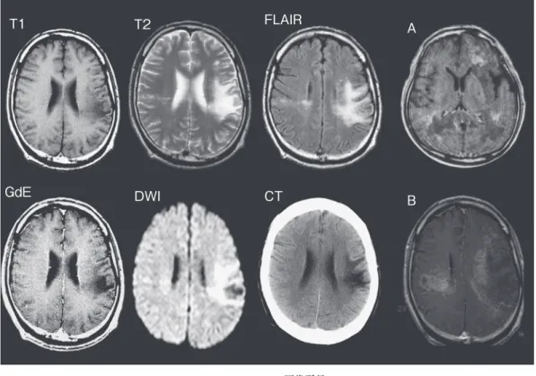 Fig. 1 PML の画像所見 皮質下白質を中心とした拡散強調像，FLAIR 像，T 2 強調像で高信号，T 1 強調像，CT にて低信号あ るいは低密度を呈する地図状〜不規則な病変が多い．よくみると U 線維はもちろん皮質も障害され ている．ふつうガドリニウム造影検査では陰性である．A と B は各々別の症例の MRI T 1 強調ガド リニウム造影陽性所見で，免疫再構築症候群や炎症反応の強い PML ではこのように造影効果や腫瘤 効果を示すことがある．T1 T2 FLAIRGdEDWI CT A B 