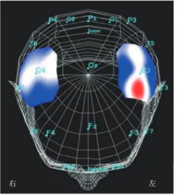 Fig. 2 脳梗塞 25 歳，右前頭葉梗塞，左片麻痺例の NIRS；3-D マッピングと ROI 解析所見．