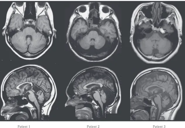 Fig. 1 Representative  brain  MRI  findings  (T 1  weighted).  Axial  (upper)  and  sagittal  (lower)  slices  in  three  patients  with  ARSACS.  In  these  patients,  cerebellar  atrophy,  especially  in  the  upper  vermis, can be seen. In addition, a m