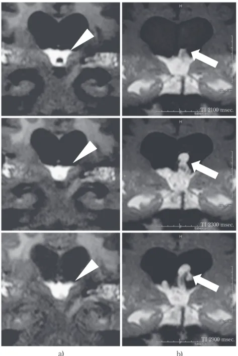 Fig. 2 Series of time dependent coronal images time-SLIP MR images in a hydrocephalic brain. a)  CSF  does  not  reflux  into  lateral  ventricles  (arrow  head)  in  hydrocephalic  brain.  b)  CSF  reflux  into the alteral ventricle from the third ventric