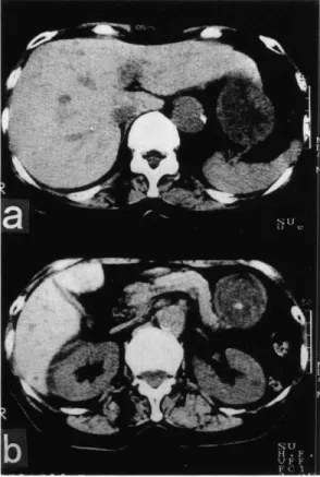 Figure  2.  Abdominal  plain  CT  scan  revealed  no  findings  of  extrahepatic  biliary  obstruction  (a)