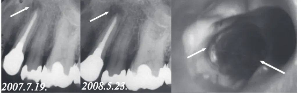 Fig. 　5　   Isolated perilateral radiolucency with fracture  line（ ）