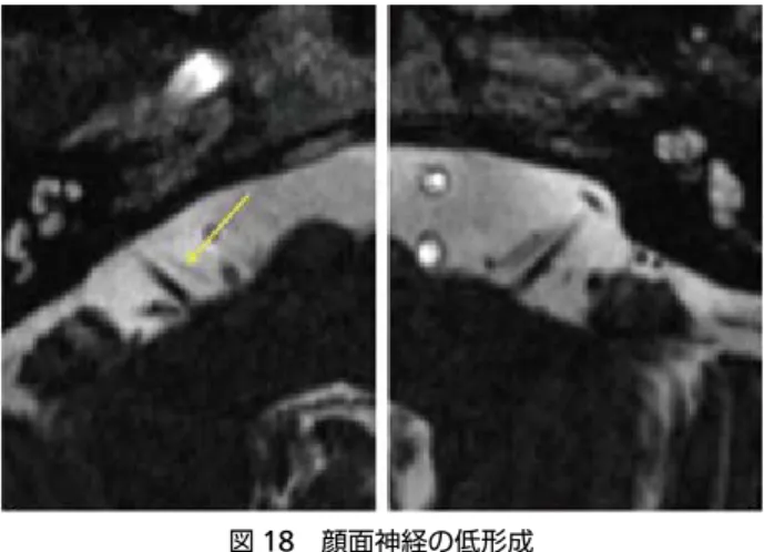図 18 　顔面神経の低形成 MRI T2 強調軸位断像．右顔面神経が左側と比較して低形成であ る（→）．なお、両側聴神経は正常である． 図 19 　塊椎　 非造影 CT 矢状断再構成像．頚椎・胸椎（ C3-C5, C6-T2 ）の椎 体および椎弓は癒合している（→）． 図 20 　肝左葉外側区と内側区の分葉不全 非造影 CT 横断像．肝円索裂？はわずかに認められる程度で、低形成の状態と思われる（→）．