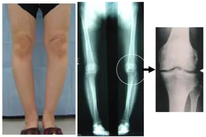 図 1-1 膝 OA 患者の立位膝関節正面の X 線写真画像  膝 OA の治療は，観血的治療と保存的治療に大別され，大多数は保存的治療が適応とされ る 1-11) 。大森 1-12) は，日本の一地域における 28 年間におよぶ長期縦断疫学調査により，膝 OA の進行は緩徐であり，約 30 年の経過で手術に至るのは 10%以下であったと報告した。 このことは，膝 OA の治療において保存的治療が主体であることを裏づけるものであった。  膝 OA の保存的治療は，薬物療法，装具・足底挿板療法，物理療法などか
