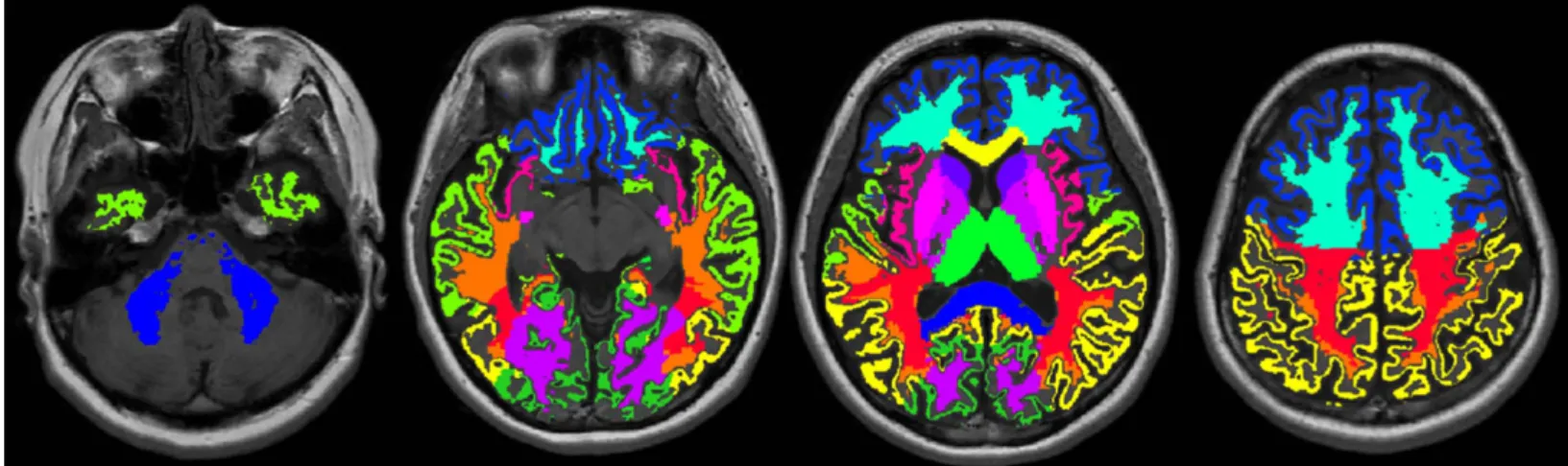 FIGURE 1. Example of volume of interest measurement. Volumes of interest are overlaid on T1-weighed images.