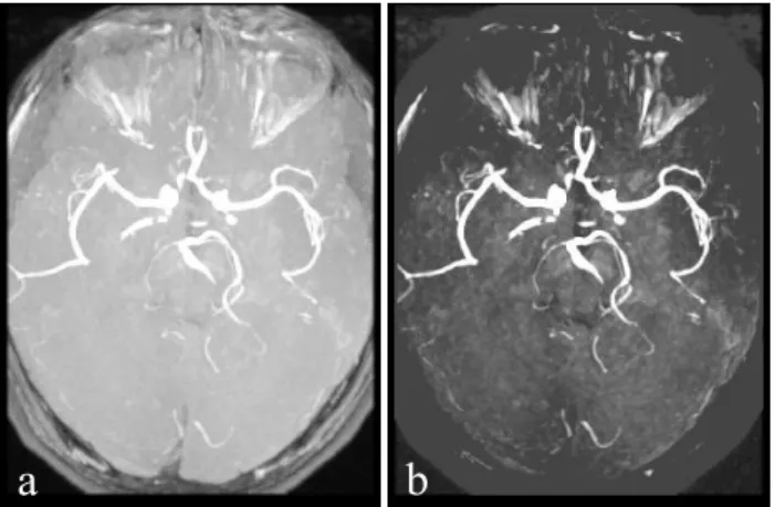 Fig. 2 Enhancement of vessel regions based on a non-linear gray-scale transformation. （a） An original MRA image.