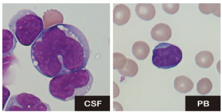 Fig. 1    Morphological characteristics of the lymphocytes in cerebro- cerebro-spinal fluid (CSF) and peripheral blood (PB)