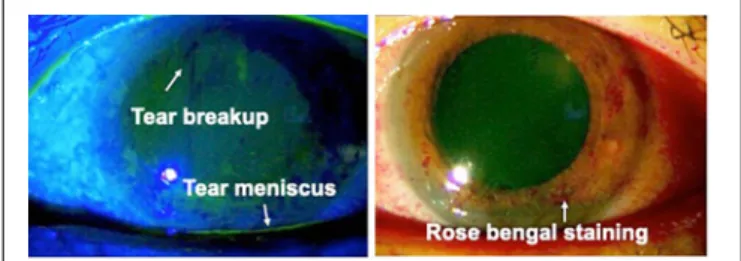 FIGURE 3 | Keratoconjunctivitis sicca (KCS) in an HTLV-1-infected patient.