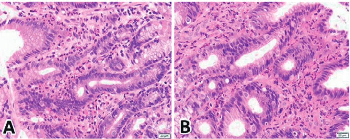 Fig. 2. Hematoxylin &amp; Eosin stain showing eosinophil infiltration of more than 40/ high power field. (A) Stomach. (B) Duodenum