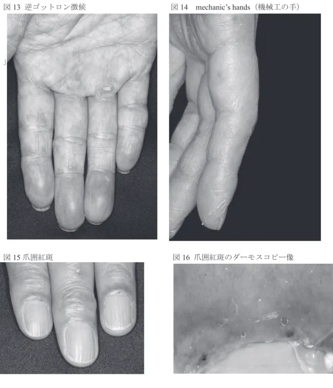 図 13  逆ゴットロン徴候                         図 14  mechanic’s hands （機械工の手）    