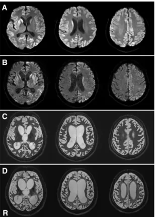 図 2. MM1 型孤発性 CJD の頭部 MRI 像 (A)発症 1 ヵ月後の DWI で大脳皮質、線条体に、右側優位に高信号を認める。  (B)発症 5 ヵ月後の DWI では大脳皮質、線条体の高信号は左側優位になり、脳萎縮が進行してい る。 ( C )発症 12 ヵ月後の T2 強調像では、脳萎縮が進行しているが、白質病変はまだ目立たない。  (D)発症 24 ヵ月後の T2 強調像では、広範な白質病変が出現し、脳萎縮が進行している。  R：右側。  表 1