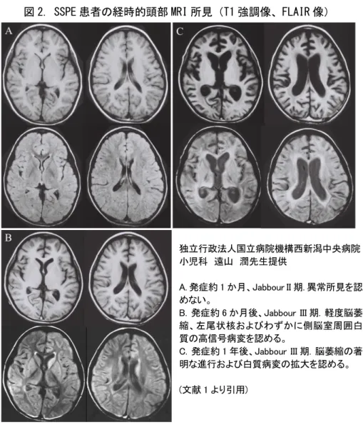 図 2. SSPE 患者の経時的頭部 MRI 所見（T1 強調像、FLAIR 像） 