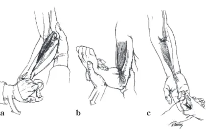 Fig.  3 Provocative tests for median nerve entrap- entrap-ment in the proximal forearm （Reproduced  with permission of the copyright owner 5） ）  a ：Pain  in the proximal forearm provoked by resistance 