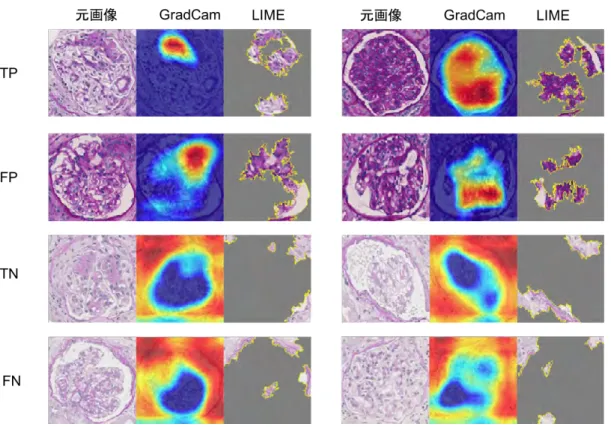 図 5 (a)  Mesangial hypercellularity を分類する CNN の着目点の可視化例。TP は新陽 性、FP は偽陽性、TN は真陰性、FN は偽陰性を意味する。 