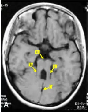 図 1  Molar Tooth Sign (MTS)の画像とその特徴（MRI T1 強調画像） 