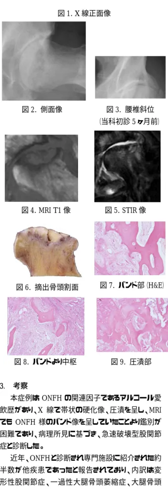 図 4. MRI T1 像              図 5. STIR 像 
