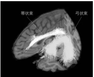 図 ３ 健 常 女 性 が 健 常 男 性 よ り 有 意 に Fractional Anisotropy の低下を示した白質 繊維束。健常女性の一例。  （産業医科大学での予備解析）  神経性食思不振症制限型 9 例 (AN 群 ) と健 常対照群に 25 名 ( 対照群 ) について、