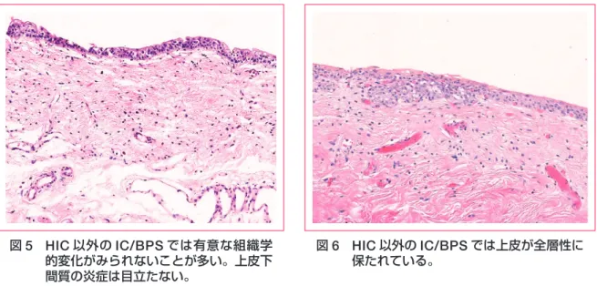 表 4 　 HIC と HIC 以外の IC/BPS の病理組織像