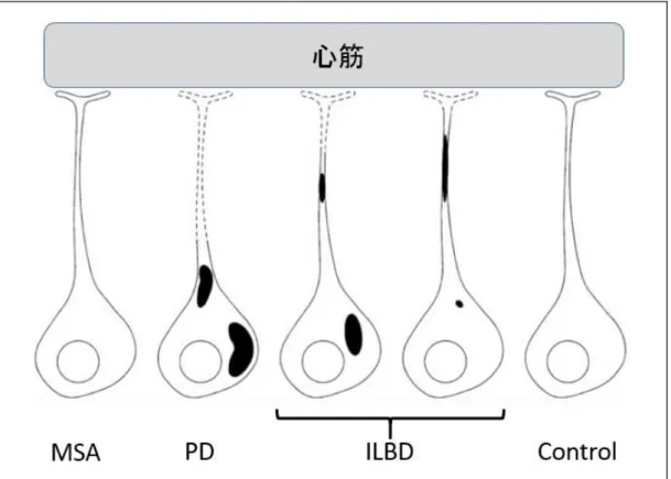 図 1.13  LBD 疾患における心臓交感神経の変性 