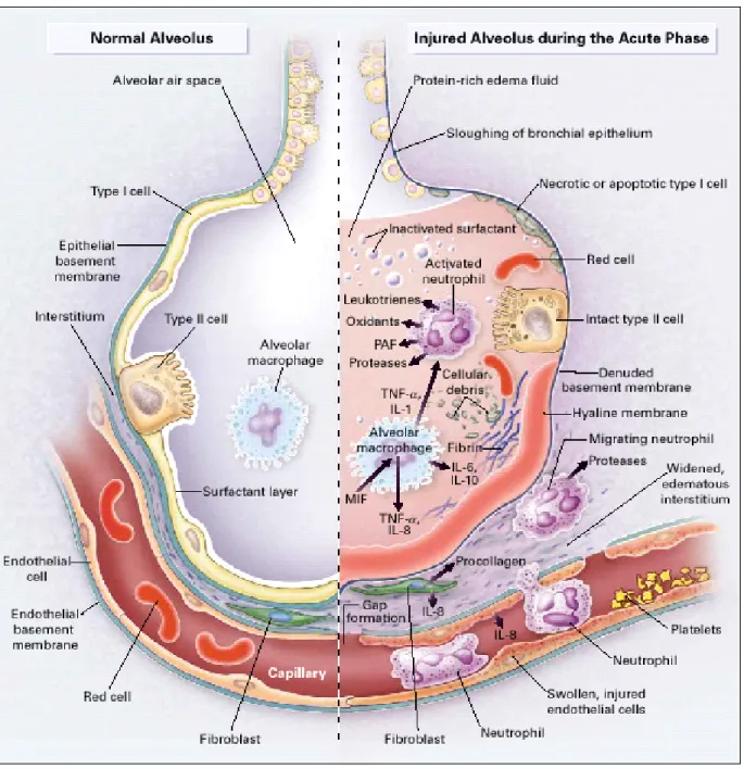 Fig. 2.  Pathophysiolocal features of ARDS/ALI  1)