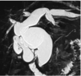 Figure 1. 先天性胆道拡張症の MRCP 像． も有症状時に一過性にみられ，症状が治まると異 常であった検査値も正常化することから，血液検 査の異常も合併症によるものが多い． CQ-II-3 先天性胆道拡張症のスクリーニ ングに US は有用か？ ・US は総胆管・肝内胆管の拡張や胆嚢壁 内側の肥厚を描出し，先天性胆道拡張症の診 断の契機となる．先天性胆道拡張症のスク リーニングに有用であり，実施することを推 奨する（推奨度 1，レベル B）． ＜解説＞ 先天性胆道拡張症の診断において US は簡便