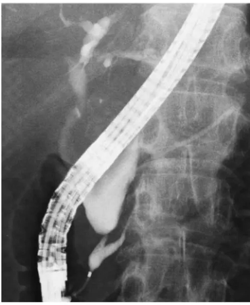 Figure 2. 先天性胆道拡張症の ERCP 像：共 通管長 15mm の膵・胆管合流異常と総胆管の紡 錘状拡張を認める． 流異常は，膵管と胆管が異常に長い共通管をもっ て合流する，あるいは異常な形で合流する所見よ り診断される（Figure 2） ２８） ． ERCP は，膵胆管合流部の詳細な解剖を明瞭に 描出できるが，膵炎などの偶発症を伴う検査であ り，特に小児の先天性胆道拡張症の診断において は，その適応は他の画像所見と併せて慎重に決定 すべきである ２６） ． CQ-II-6 先天性胆道拡張症の