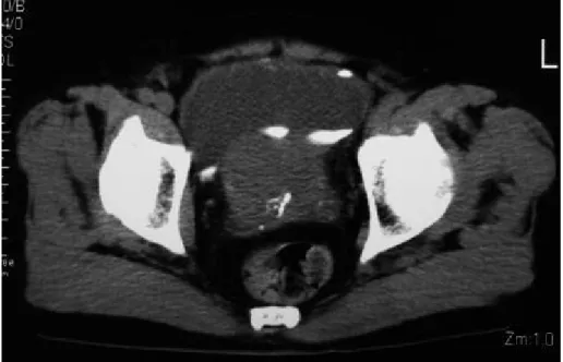 図 7  骨盤 CT 像  前立腺の肥大が認められる。 