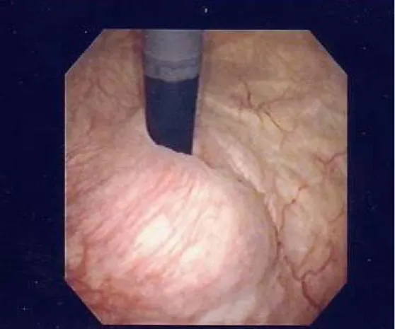 図 4  膀胱の内視鏡所見  膀胱内に突出する前立腺腺腫が認められる。 