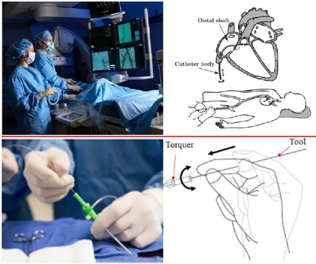 Figure 1-1 Endovascular procedures and tool manipulation [4-7] 