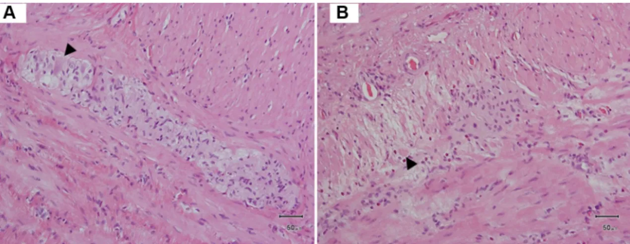 Fig. 1    The typical pathology of acquired hypoganglionosis (Case 5). 